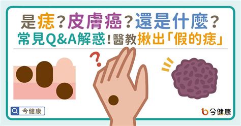 為什麼身上會有痣|是痣or皮膚癌？醫「1張圖秒對照」 長這2部位最危險